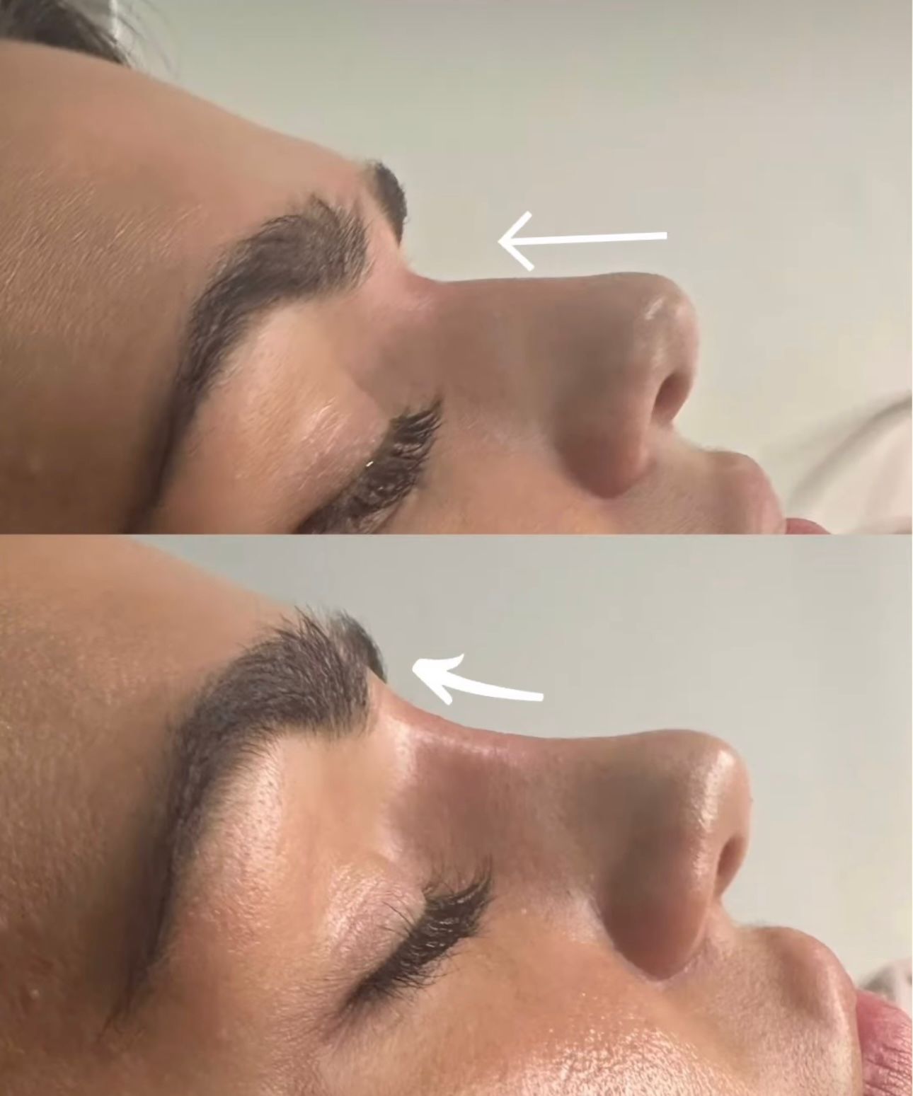 Non-Surgical Rhinoplasty